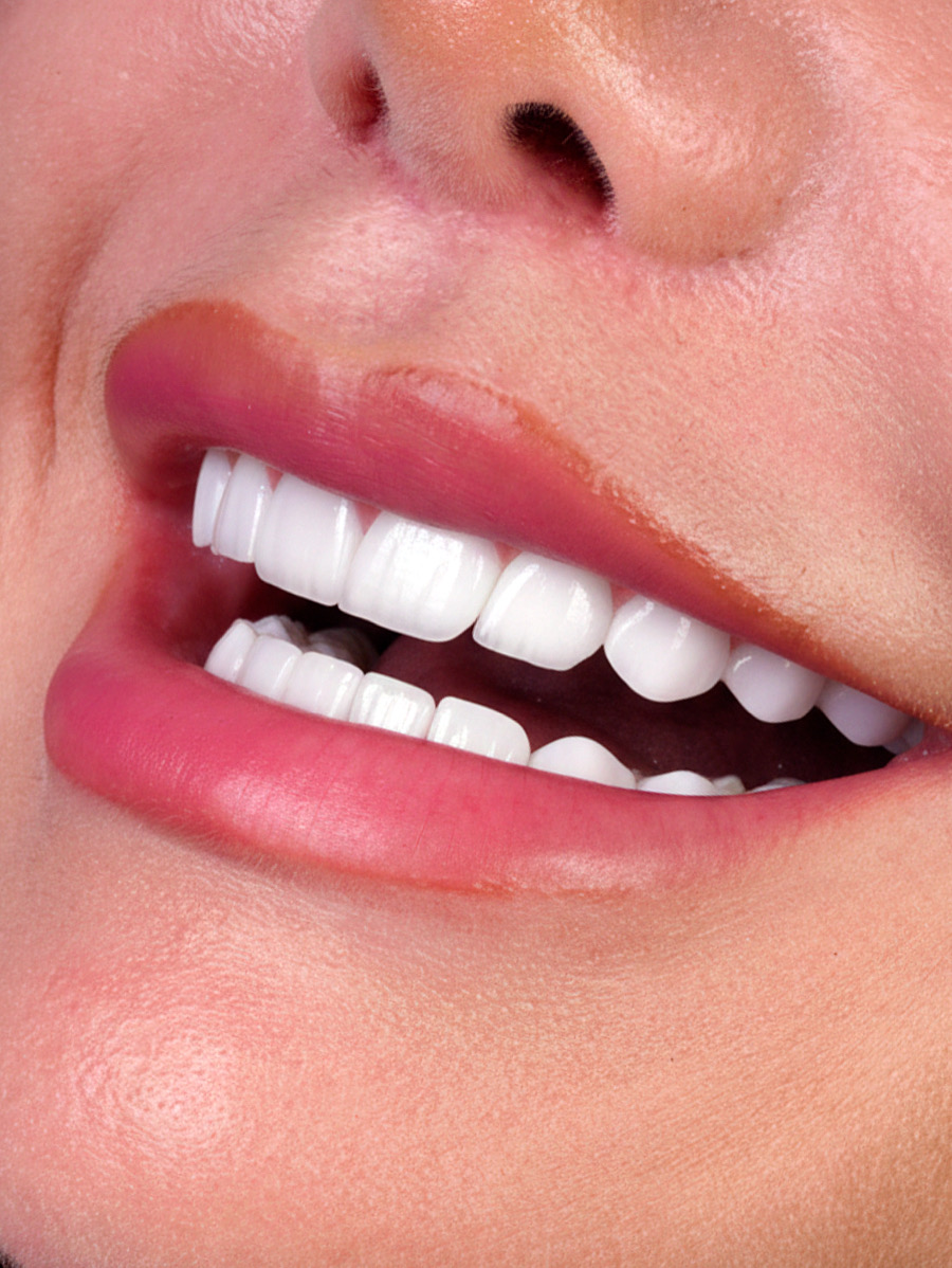 HD Veneer - Real Patient Case