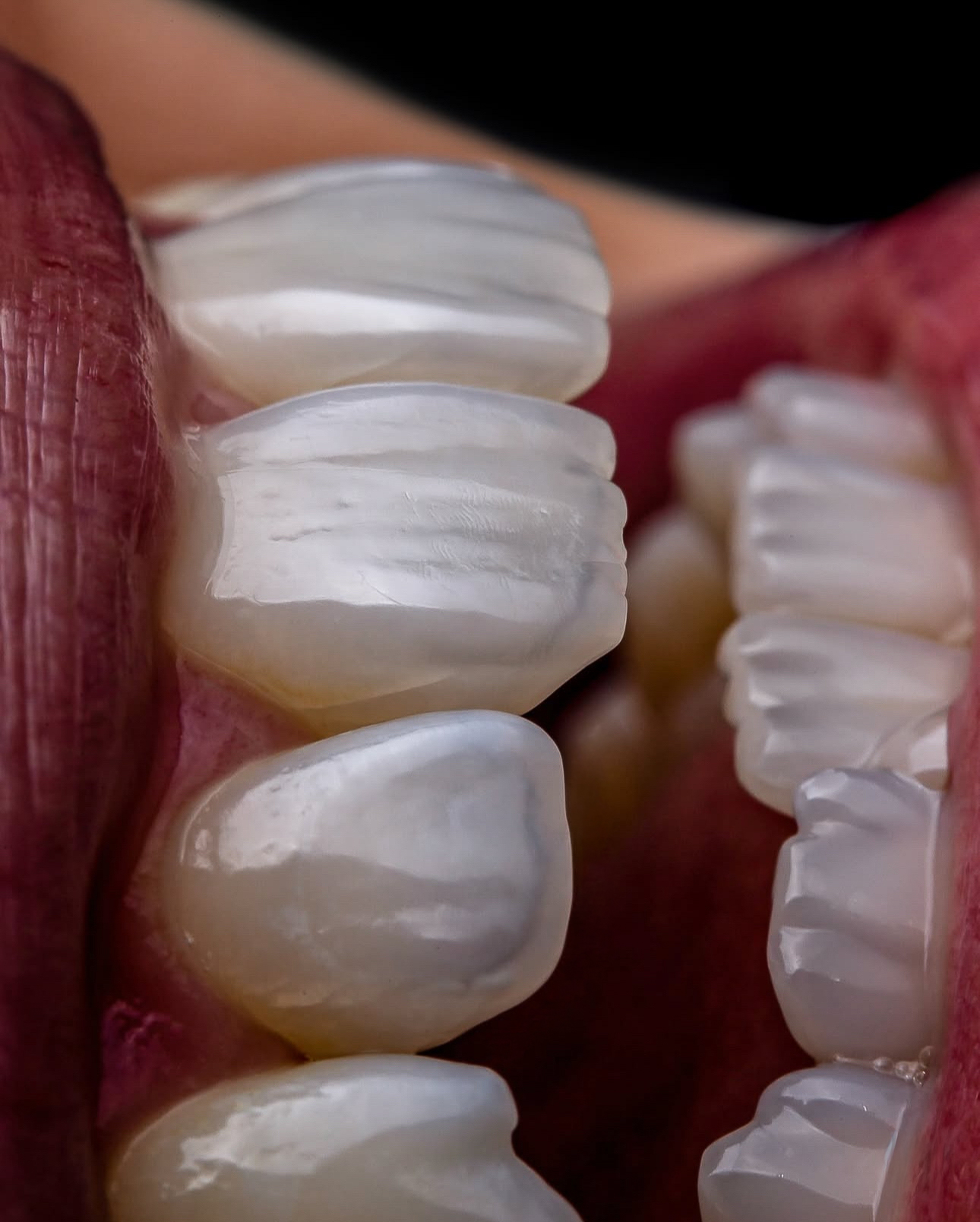 HD Veneer - Real Patient Case