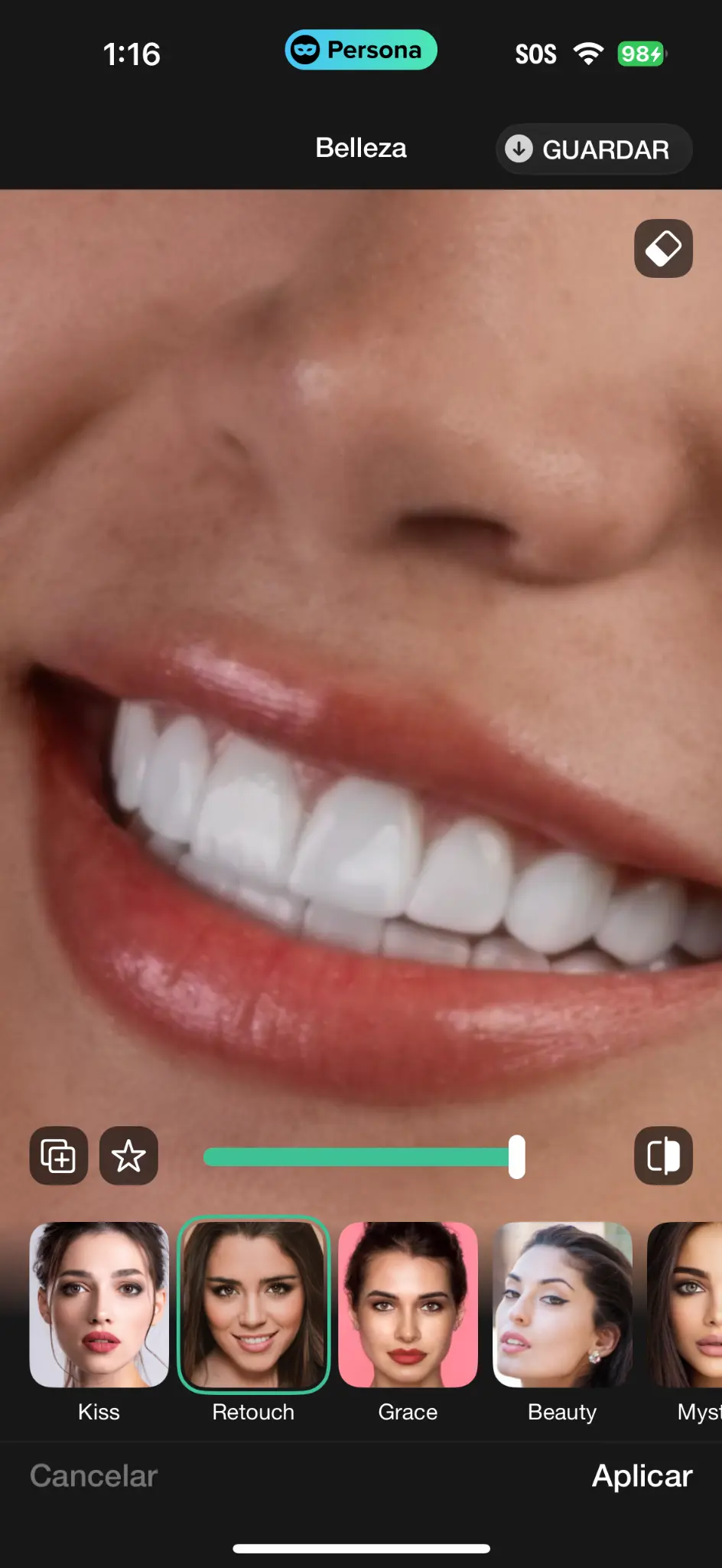 HD Veneer - Real Patient Case