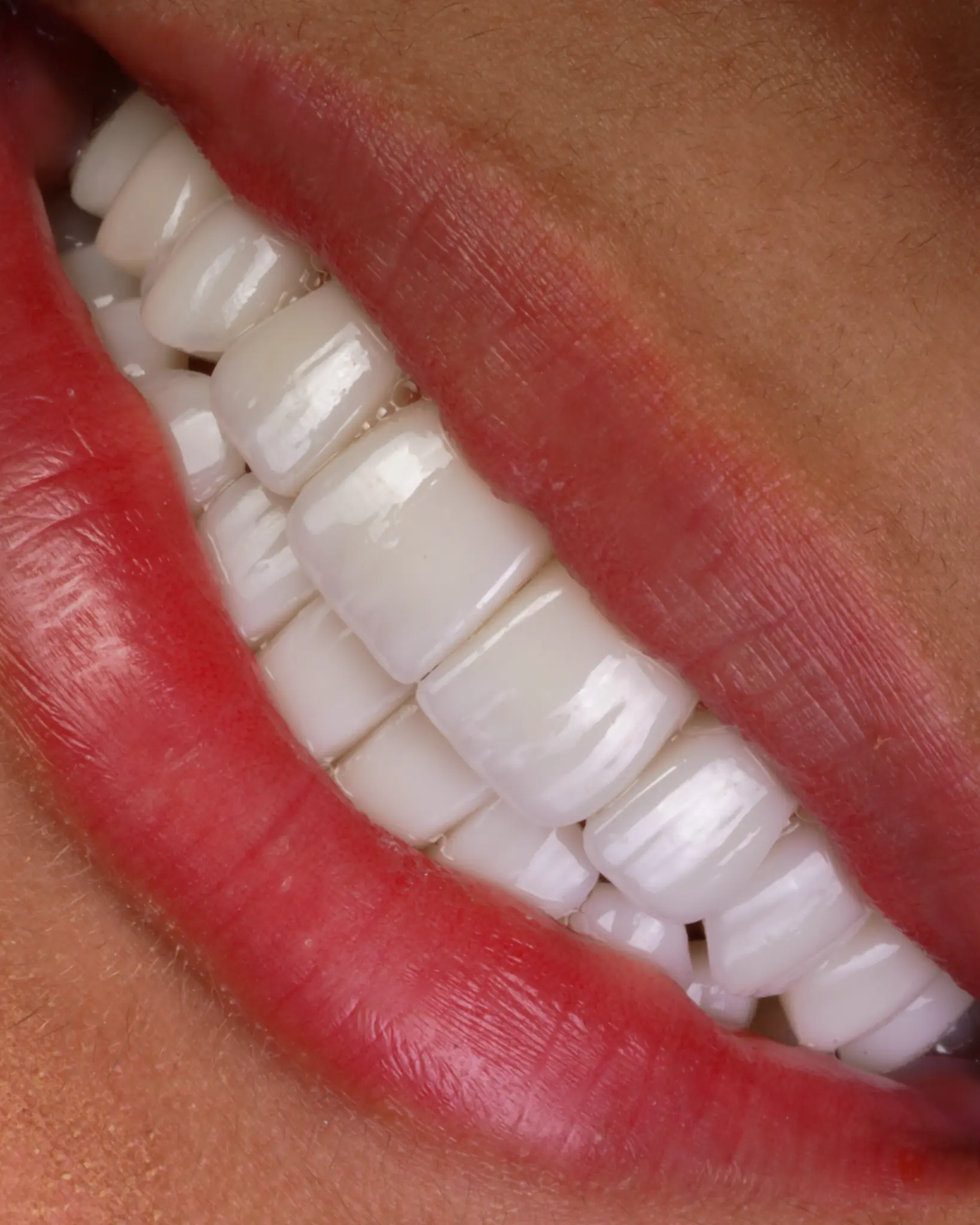 HD Veneer - Real Patient Case