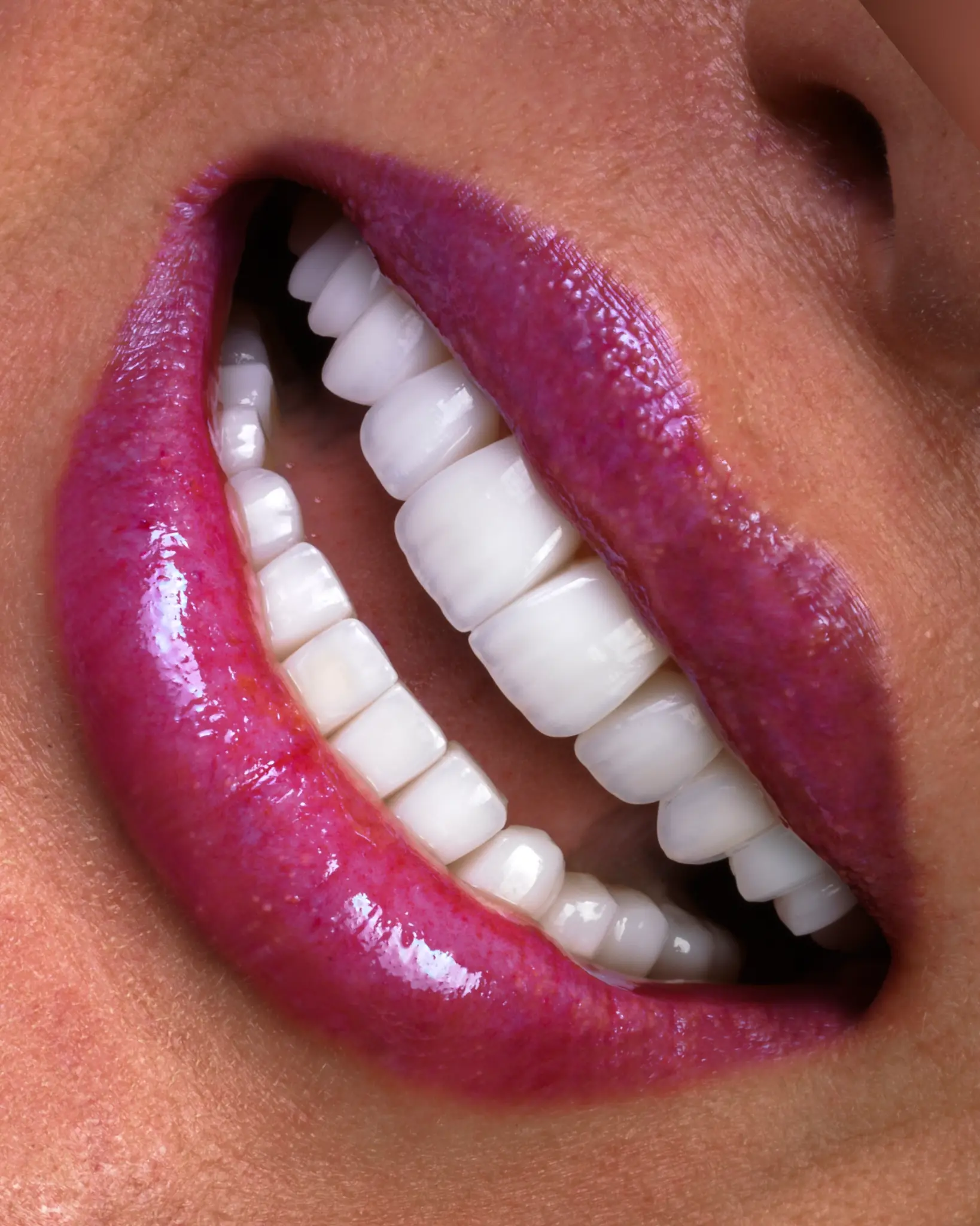 HD Veneer - Real Patient Case