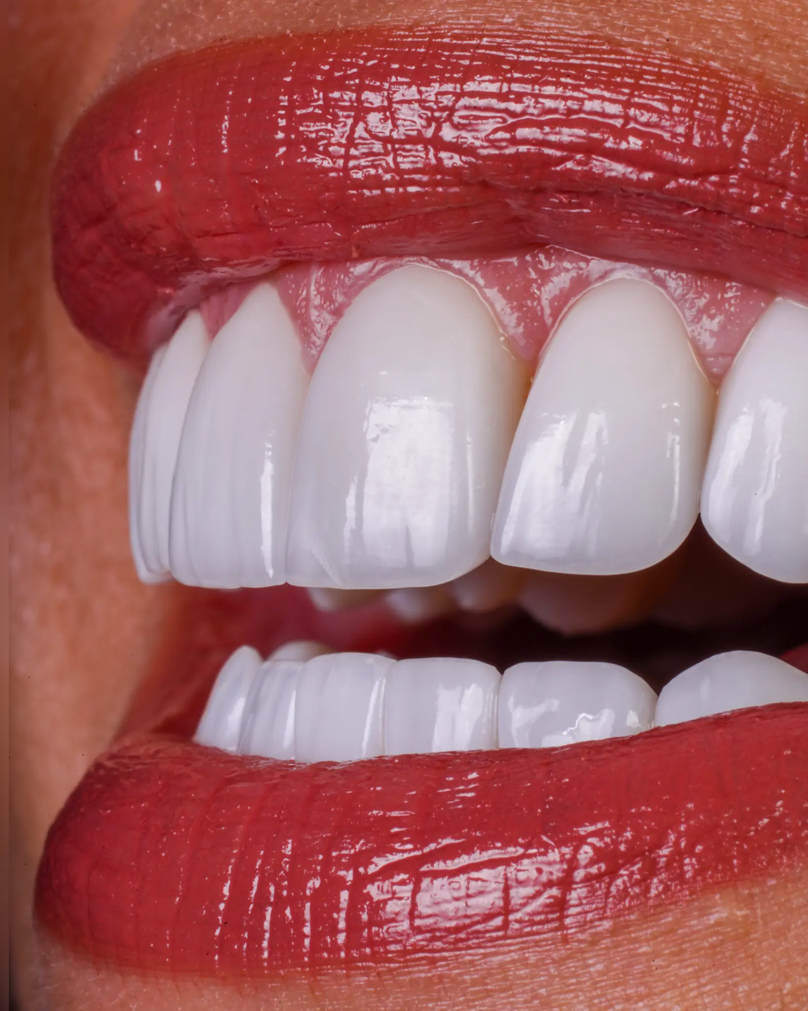 HD Veneer - Real Patient Case