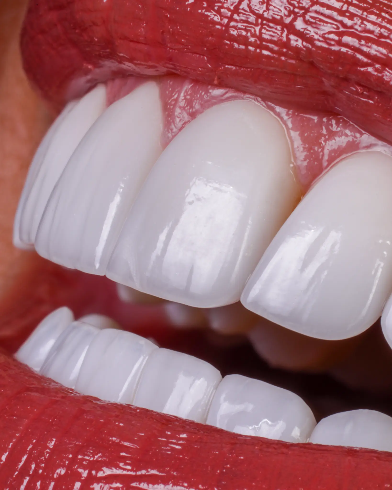 HD Veneer - Real Patient Case