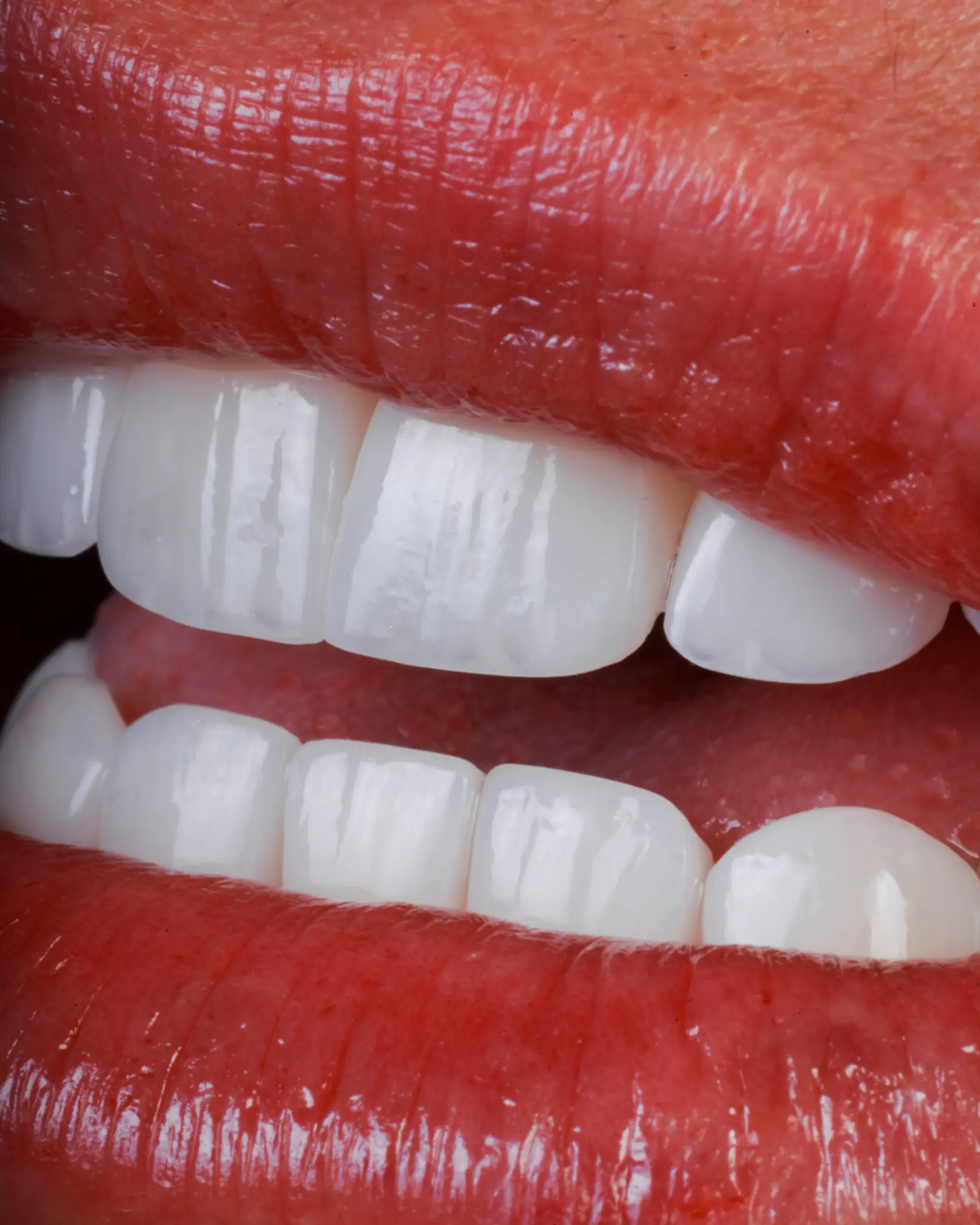 HD Veneer - Real Patient Case