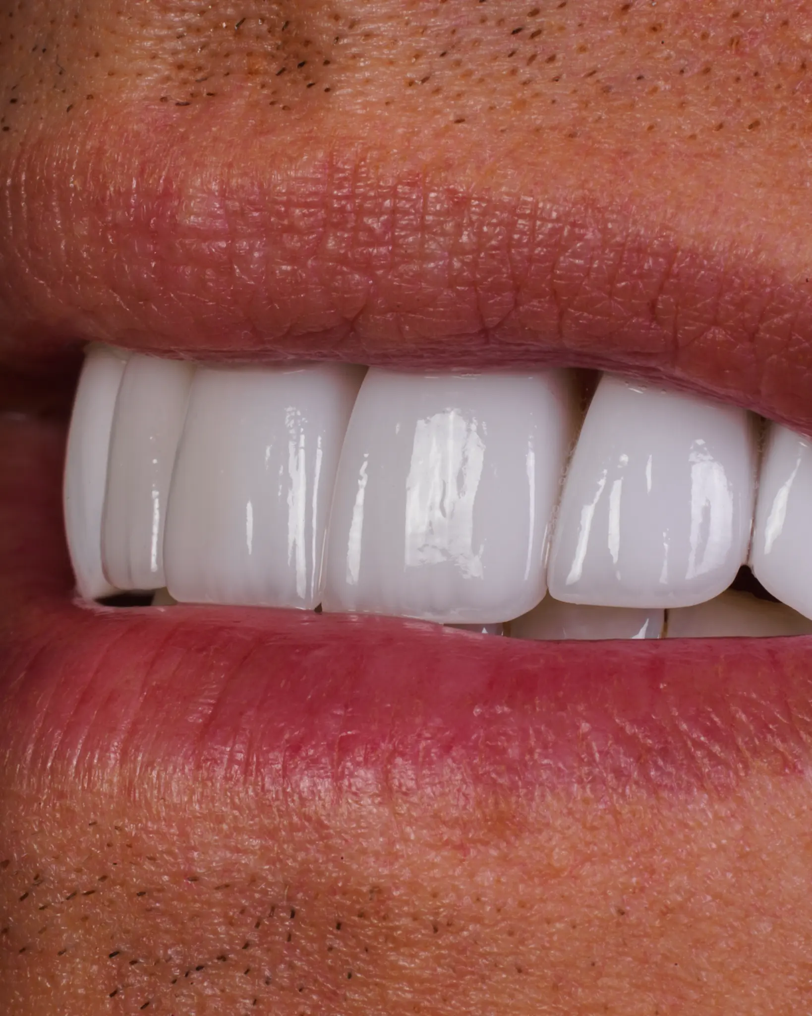 HD Veneer - Real Patient Case