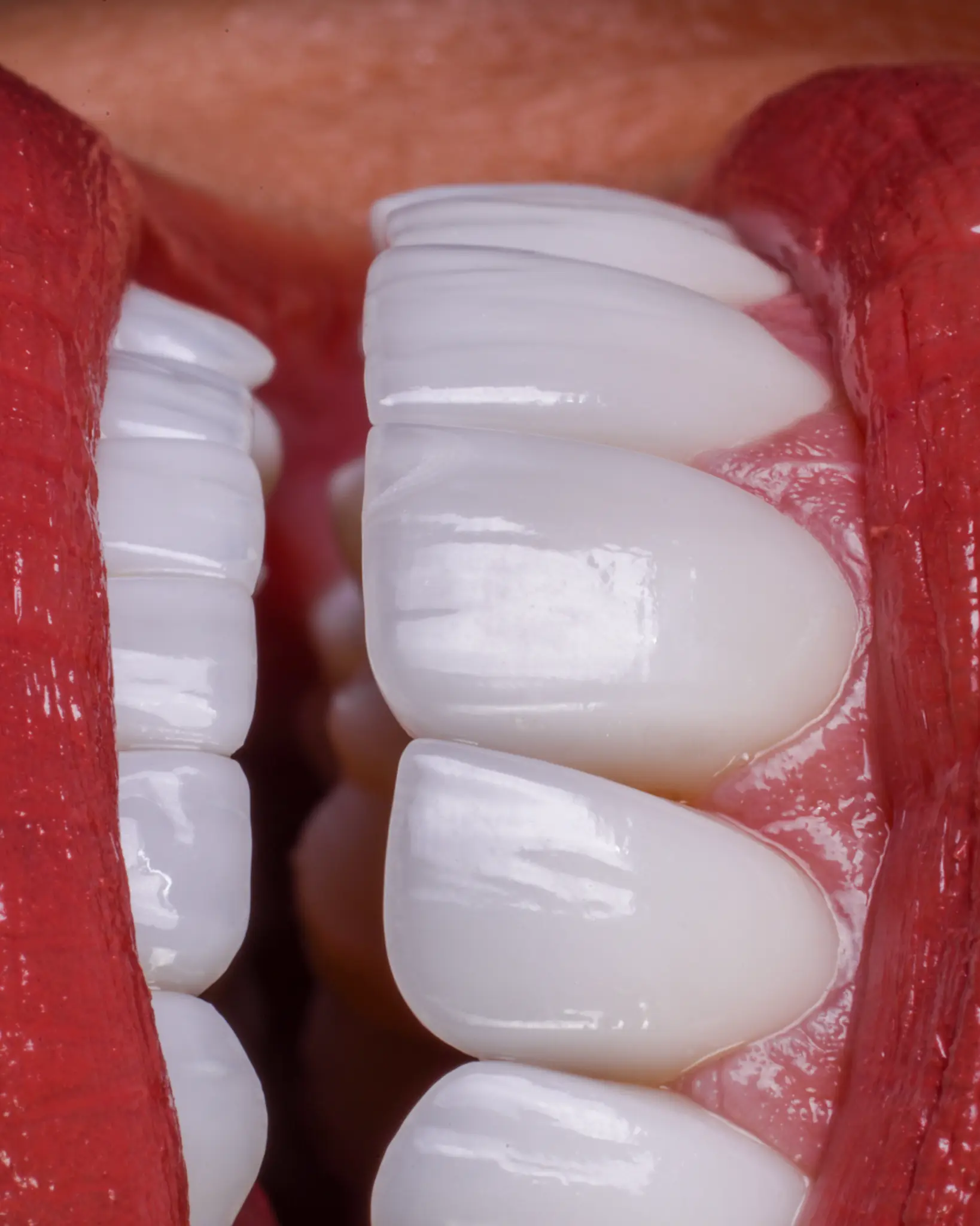 HD Veneer - Real Patient Case