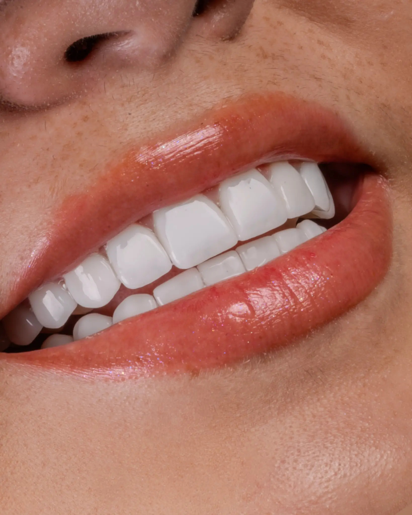 HD Veneer - Real Patient Case