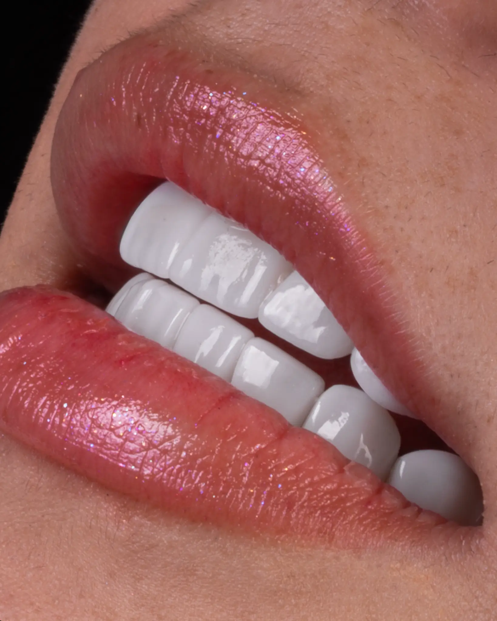 HD Veneer - Real Patient Case