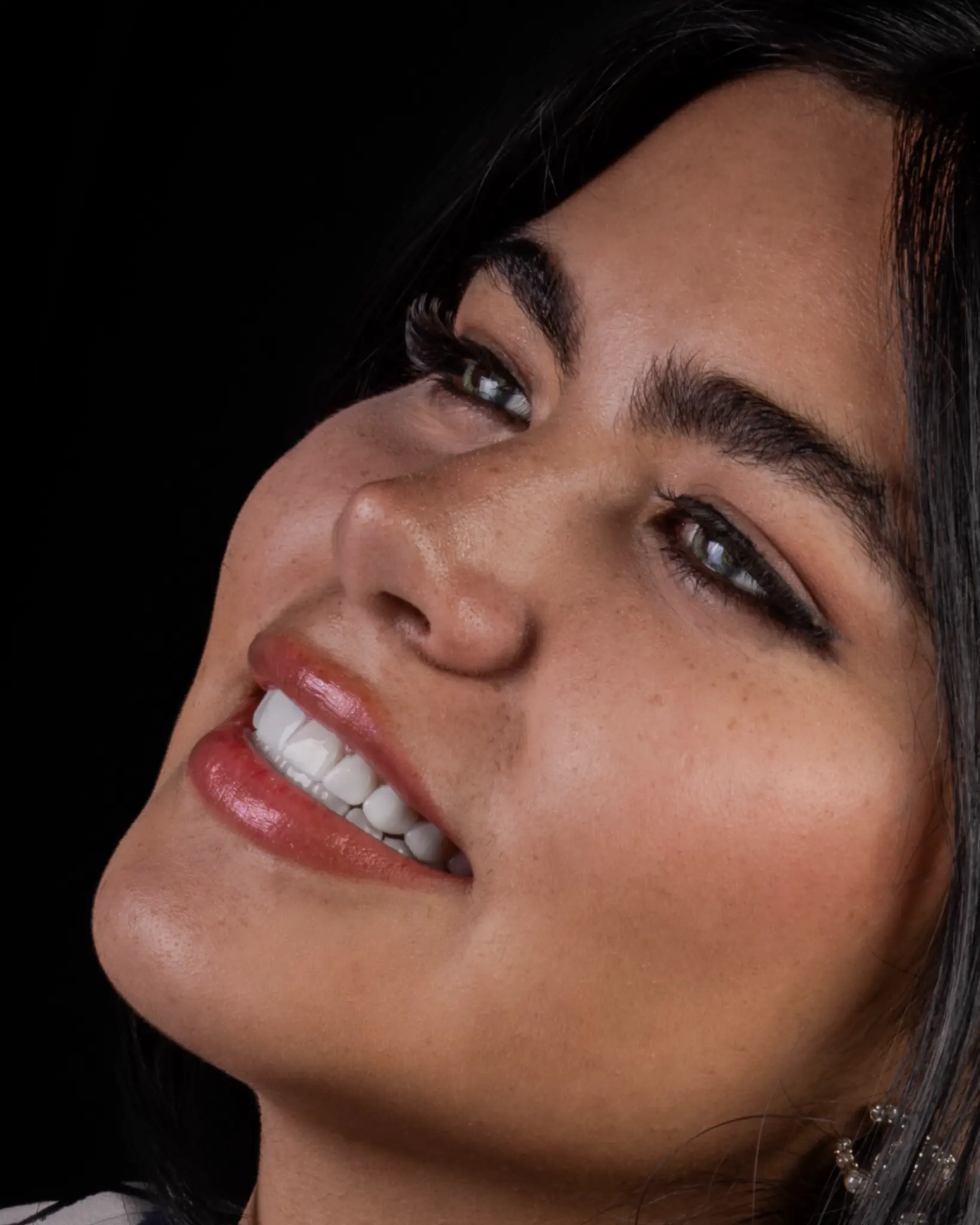 HD Veneer - Real Patient Case