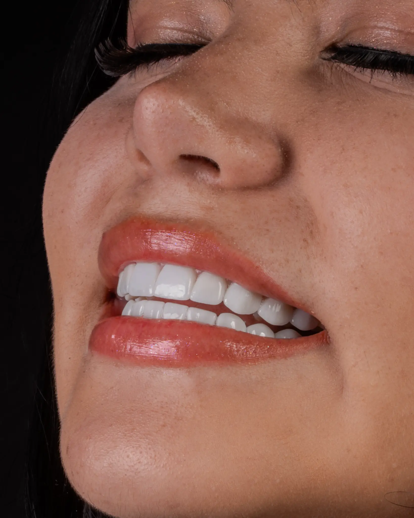 HD Veneer - Real Patient Case