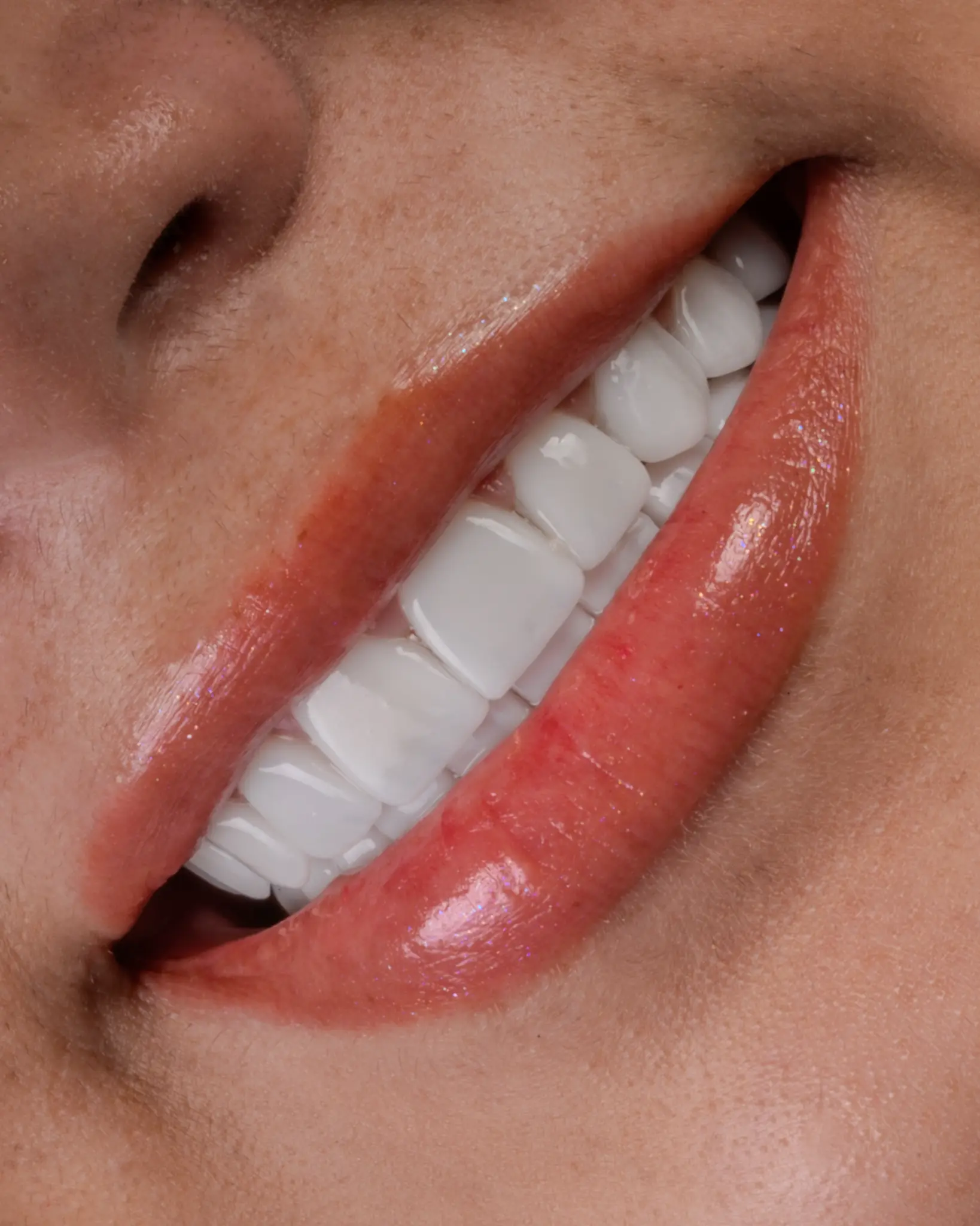 HD Veneer - Real Patient Case